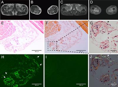 Case Report: Monoclonal Gammopathies of Clinical Significance-Associated Myopathy: A Case-Based Review